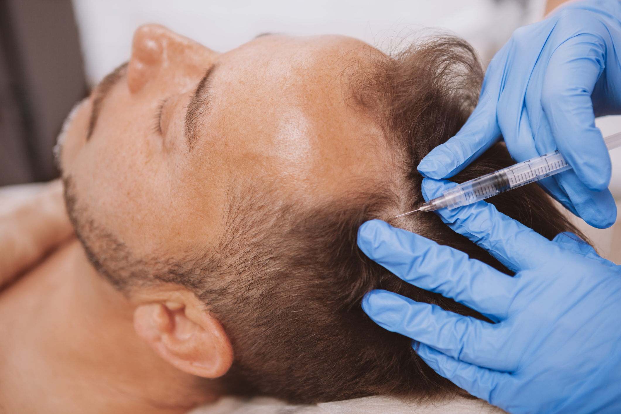mesoterapia capilar